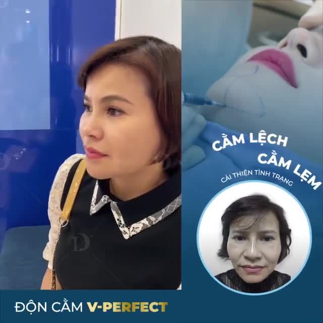 BẮT TREND MUỘN: Cùng ngắm ảnh trước và sau 2 năm khi độn cằm