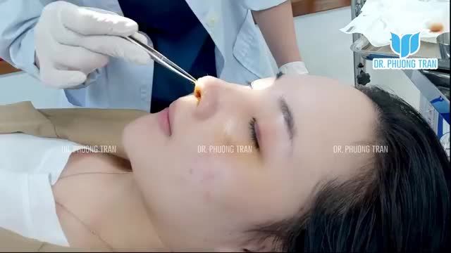 CẬN CẢNH MŨI CẤU TRÚC SURGIFORM ĐẸP TỰ NHIÊN NGAY SAU THÁO NẸP 7 NGÀY