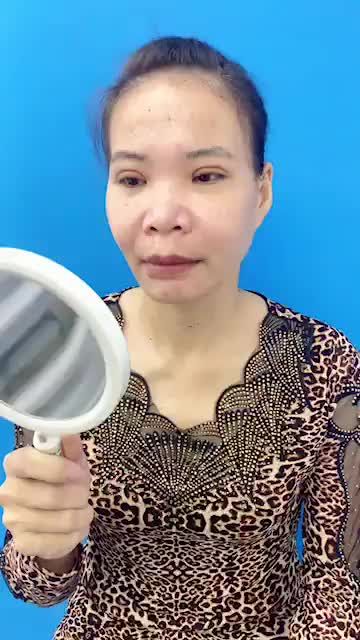 Chỉnh hàm hô - Trượt cằm - Cắt mí trên Chị khách hàng đã thay đổi như thế nào sau combo Đại tu tại Đông Á