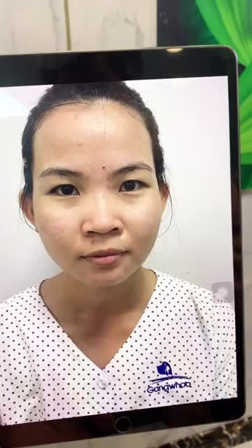COMBO NÂNG MŨI 3D THU GỌN CÁNH MŨI 3 THÁNG ĐƯỢC KHÁCH HÀNG CHẤM ĐIỂM 10
