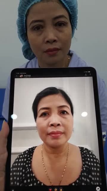 TRẺ RA 5 TUỔI SAU KHI CẮT MÍ MẮT "CHỊ SỢ ĐAU LẮM! MÀ KHÔNG HỀ GÌ LUÔN!"