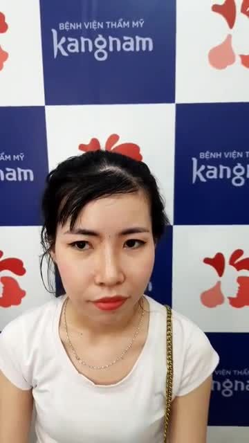 Khách hàng thực hiện dịch vụ nâng mũi cấu trúc Sline 4D cắt chỉ sau 10 ngày