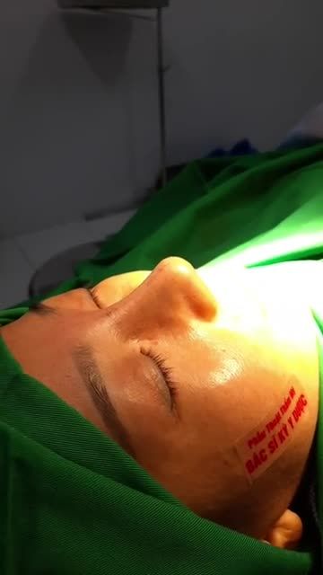 Nâng Mũi Bán Cấu Trúc Sụn Tai 2 Lớp