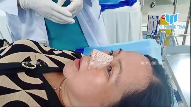 NÂNG MŨI SỤN SƯỜN TOÀN PHẦN CẬN CẢNH DÁNG MŨI NGAY SAU THÁO NẸP
