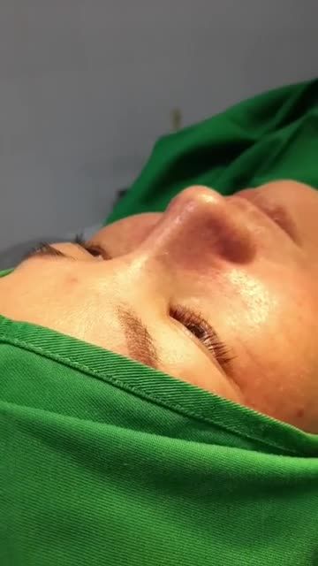 Nâng Mũi Bán Cấu Trúc Sụn Tai 2 Lớp Kết hợp cuộn cánh mũi plasma