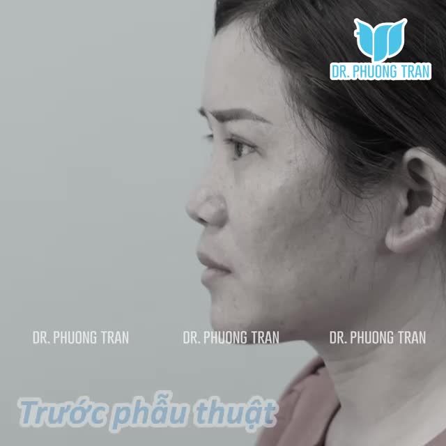 NÂNG MŨI SỤN SƯỜN TOÀN PHẦN CẤY MỠ MÍ DƯỚI TRẺ HOÁ CHỈ SAU 2 GIỜ ĐỒNG HỒ.