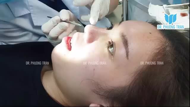 HÌNH ẢNH THỰC TẾ SAU 14 NGÀY NÂNG MŨI ĐẶT SỐNG SURGIFORM