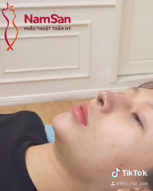 KẾT QUẢ NÂNG MŨI CẤU TRÚC SAU 5 NGÀY THÁO NẸP MŨI.