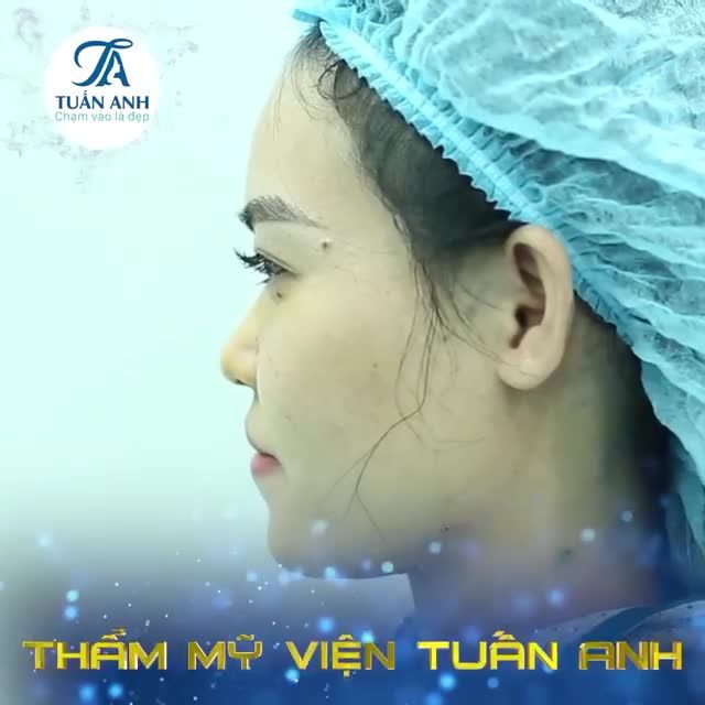 NÂNG MŨI BẰNG CHỈ COLLAGEN