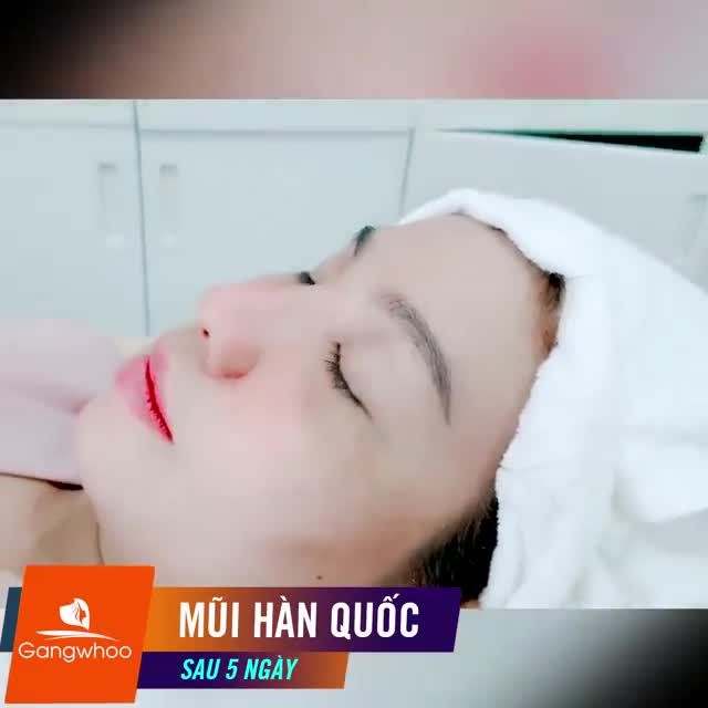 NÂNG MŨI CẤU TRÚC 4D TÁI CẤU TRÚC TOÀN BỘ DÁNG MŨI NHIỀU KHUYẾT ĐIỂM