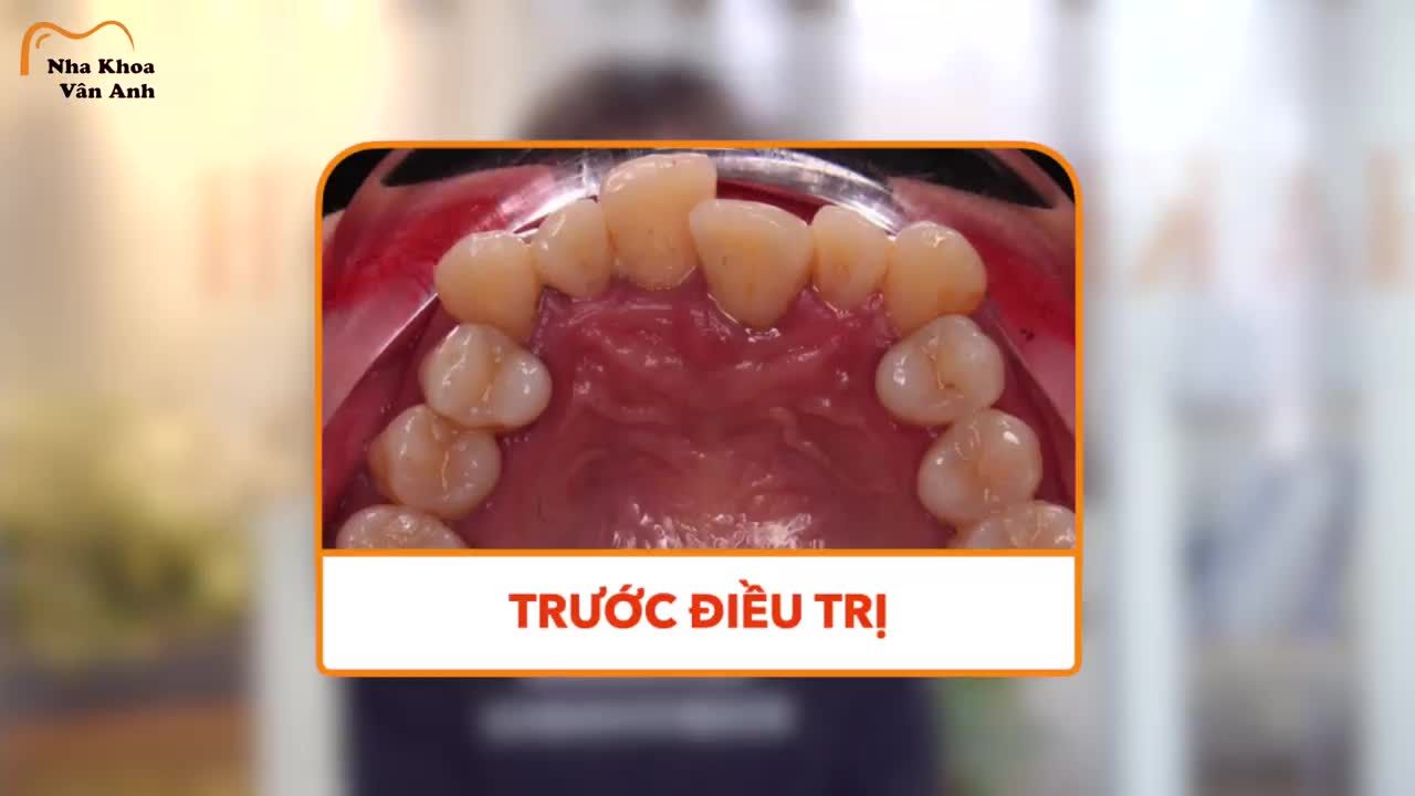 Nụ cười đẹp là khởi đầu của những điều thuận lợi. Cuộc sống của rất nhiều khách hàng tại Nha Khoa Vân Anh sau khi niềng răng đã thay đổi tích cực hơn.