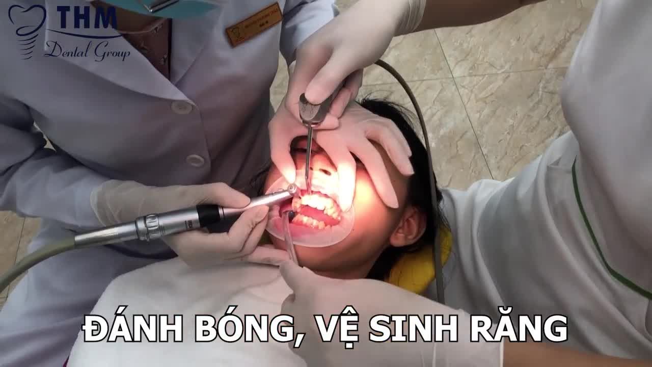 QUY TRÌNH GẮN MẮC CÀI ĐƯỢC THỰC HIỆN NHƯ THẾ NÀO?