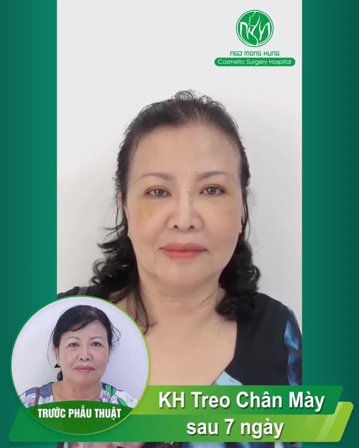 TRẺ HƠN "5 TUỔI" CHỈ SAU 7 NGÀY TREO CHÂN MÀY