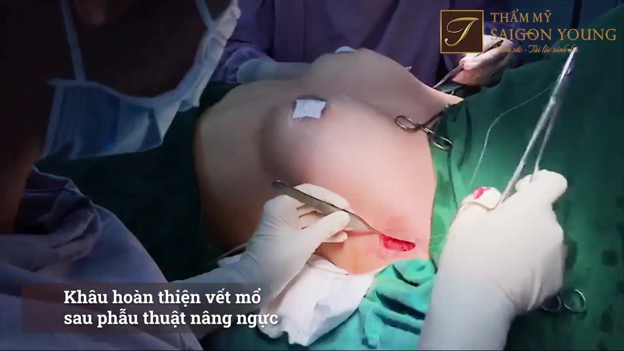 Trong phẫu thuật nâng cấp V1, một trong những điều khách hàng quan tâm là sẹo mổ.
