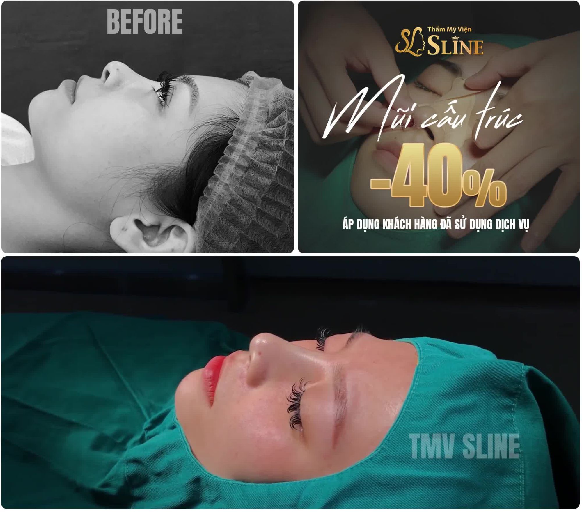 HÌNH ẢNH THỰC TẾ....sau nâng mũi cấu trúc softxil