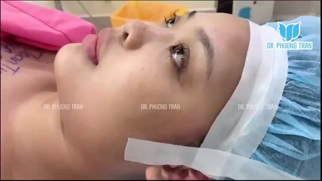 NÂNG MŨI SỤN SƯỜN TỰ THÂN TOÀN PHẦN CHO BẠN GÁI RẤT TRẺ