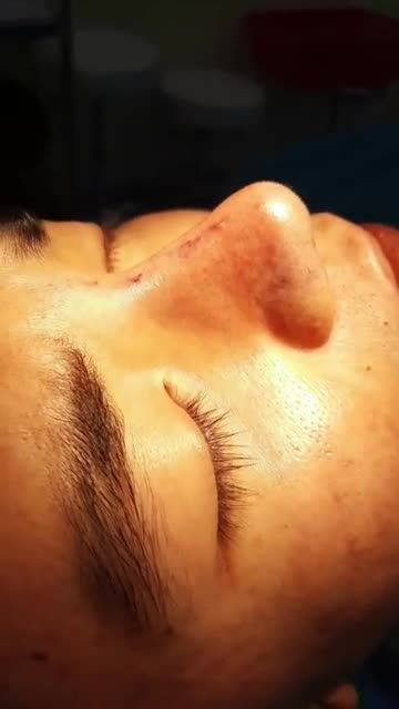 MŨI ĐẸP CHO NAM GIỚI HÓA NAM THẦN CHỈ SAU 45 PHÚT TẠI NHÀ BS KỲ Y DƯỢC