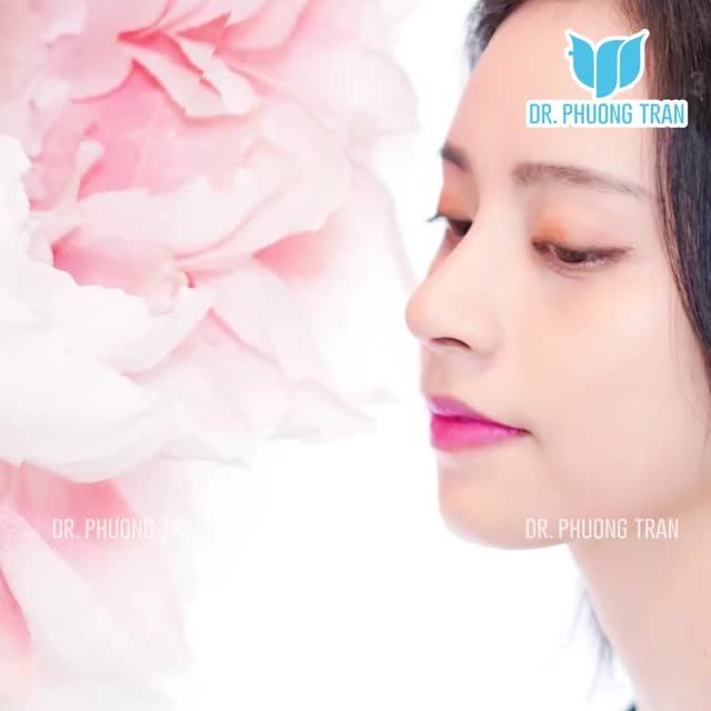 TRỌN VẸN VẺ ĐẸP VÀ CHIA SẺ CỦA KIỀU DUY SAU 14 NGÀY NÂNG MŨI SỤN SƯỜN SURGIFORM