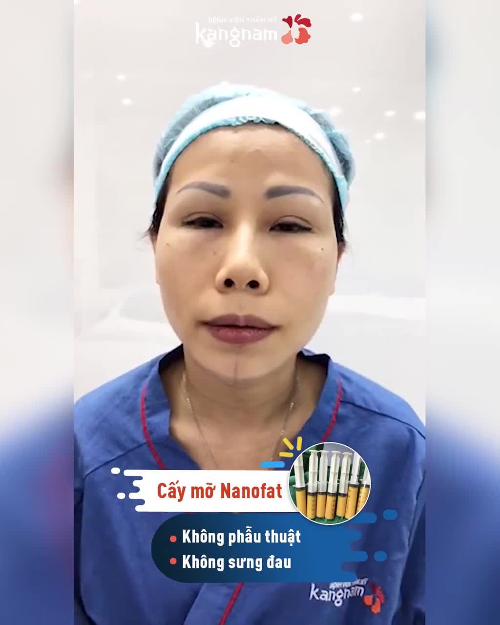 VÙNG RÃNH CƯỜI SÂU - khiến khuông mặt trở nên GIÀ NUA