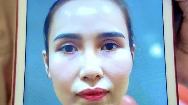 BÁC SĨ LÀM VIỆC XUYÊN TRƯA GIẢI CỨU THÀNH CÔNG CA MÍ LỖI HỎNG DO THỰC HIỆN Ở CƠ SỞ KHÔNG UY TÍN BẰNG KỸ THUẬT SỬA MÍ HỎNG DEEPTECH20