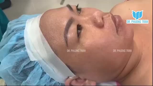 TOÀN BỘ QUÁ TRÌNH TẠO HÌNH, NÂNG MŨI BẰNG SỤN SƯỜN TOÀN PHẦN