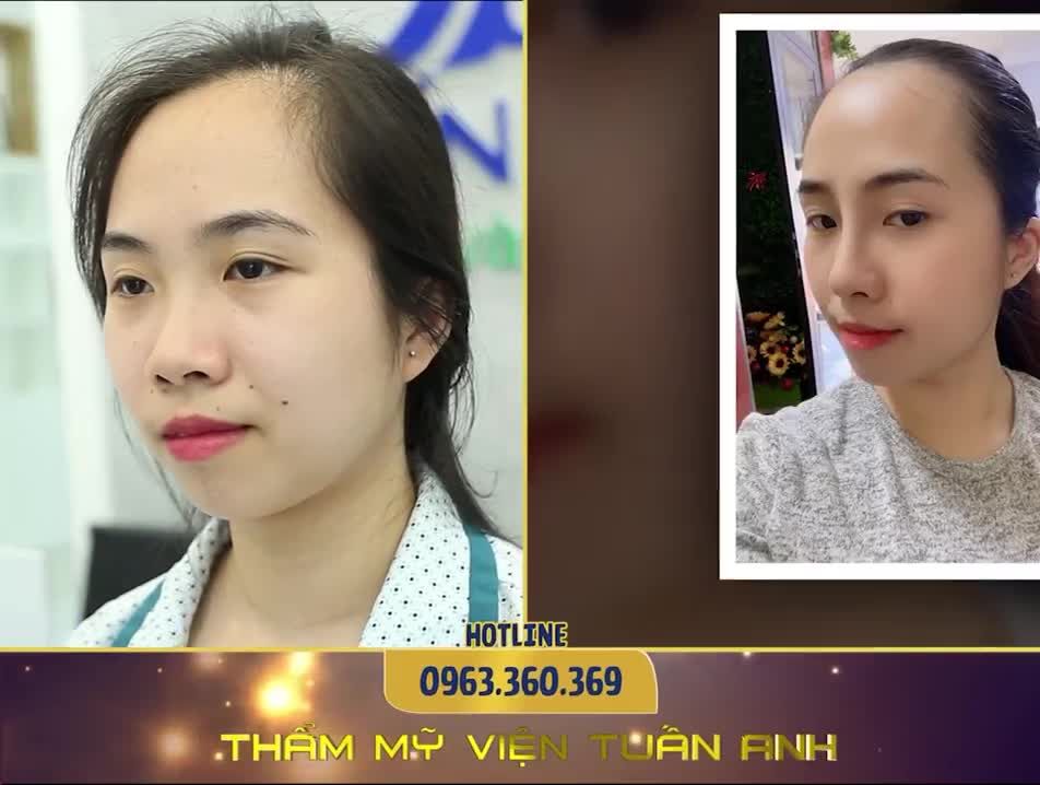 Mời các bạn theo dõi Video Feedback NÂNG MŨI S-Line của khách hàng