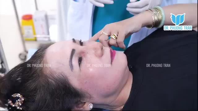THAY ĐỔI NGOẠN MỤC SAU NÂNG MŨI VÀ CẤY MỠ MI DƯỚI