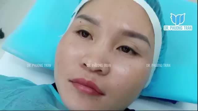 NÂNG MŨI CẤU TRÚC KẾT HỢP CẤY MỠ MI DƯỚI VÀ CẮT MÍ MẮT TRÊN
