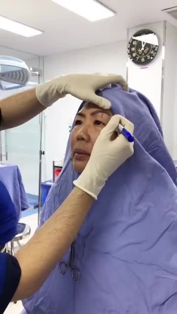 Quá trình đo vẽ trước khi làm dịch vụ nâng cung mày tại BV thẩm Mỹ ĐÔNG Á