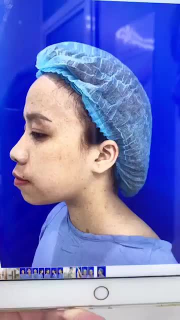 Bất ngờ với kết quả phẫu thuật CHỈNH HÔ 2 hàm thay đổi ngoạn mục của 9X