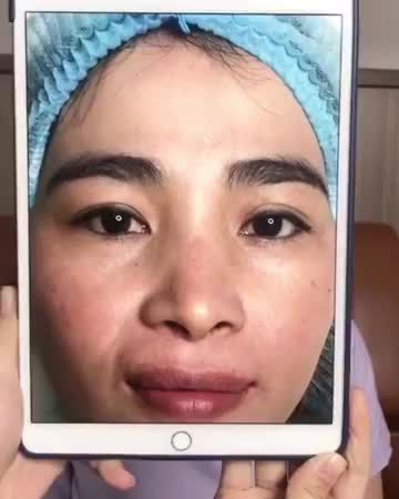 Cùng lắng nghe chia sẻ sau 3 tháng 7 ngày thực hiện Cắt mí tại chi nhánh TP.HCM để có thêm động lực làm đẹp tại Dr.Hải Lê bạn nhé.!