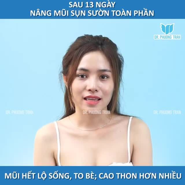 NÂNG MŨI CẤU TRÚC SỤN SƯỜN TOÀN PHẦN SỬA LẠI MŨI CŨ LỘ SỐNG VÀ KẾT QUẢ