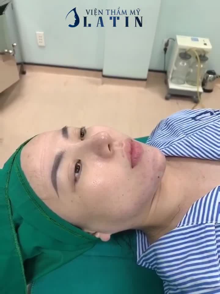 ca Độn Cằm sụn Mỹ cho em gái từng tiêm filler