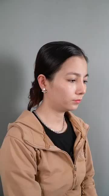 CẨN CẢNH DÁNG MŨI CẤU TRÚC SỤN SURGIFORM SAU 3 THÁNG THỰC HIỆN