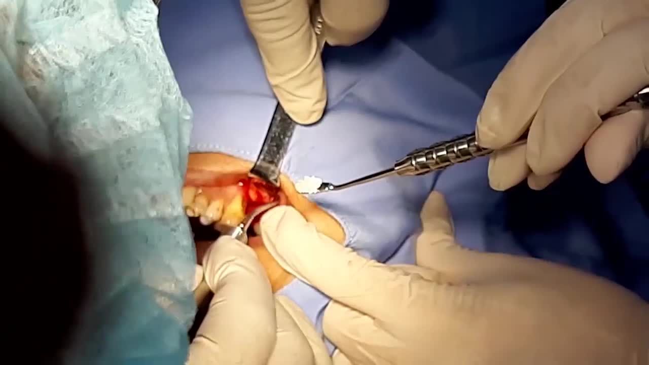 CẤY GHÉP IMPLANT RĂNG HÀM KẾT HỢP NÂNG XOANG GHÉP XƯƠNG TRONG 1 LẦN PHẪU THUẬT