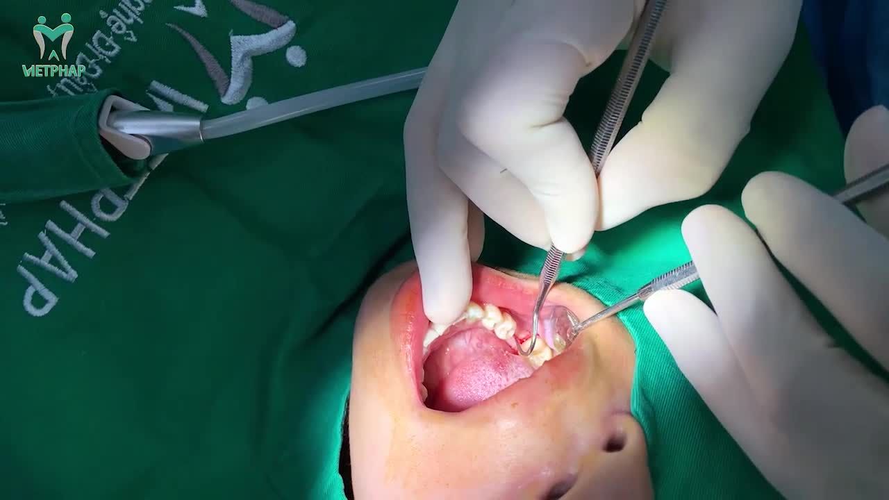 CHỈ SAU ÍT PHÚT PHỤC HÌNH XONG 2 RĂNG ĐÃ MẤT LÂU NĂM