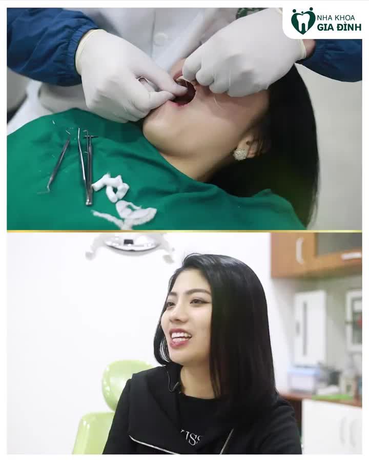 DÁN SỨ VENEER – TRẢI NGHIỆM VÀ CẢM NHẬN CỦA KHÁCH HÀNG THỰC TẾ