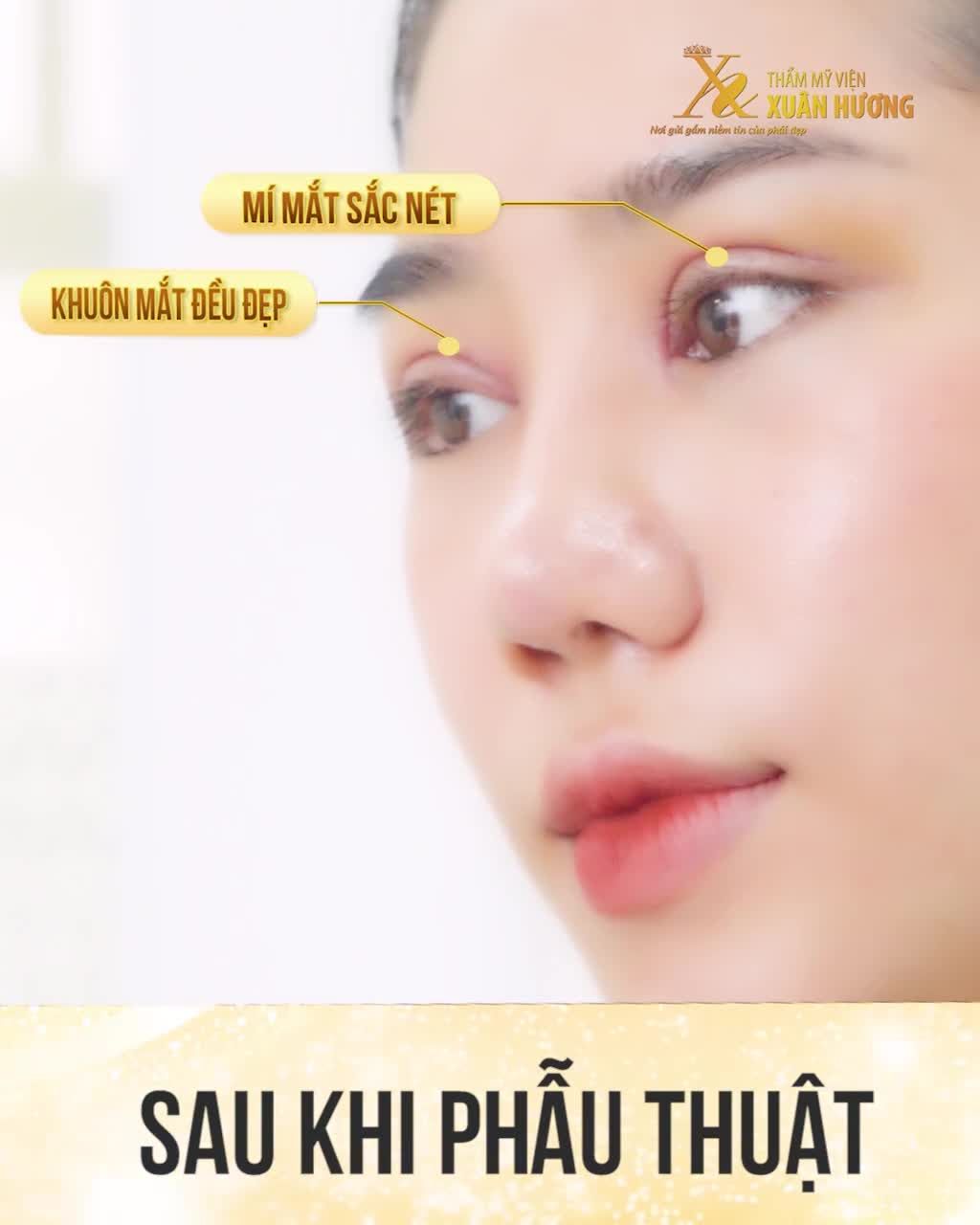 HOTFACE - NGƯỜI MẪU ẢNH ĐÌNH ĐÌNH XINH HẾT NẤC SAU COMBO CẮT MÍ + MỞ GÓC MẮT TẠI TMV XUÂN HƯƠNG