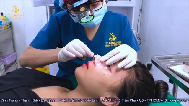Khách hàng tái khám - tháo nẹp - cắt chỉ sau 10 ngày nâng mũi cấu trúc