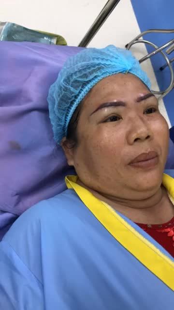 Cận cảnh kết quả sau hơn 30p thực hiện dịch vụ nâng cung chân mày tại BV thẩm Mỹ Đông Á .