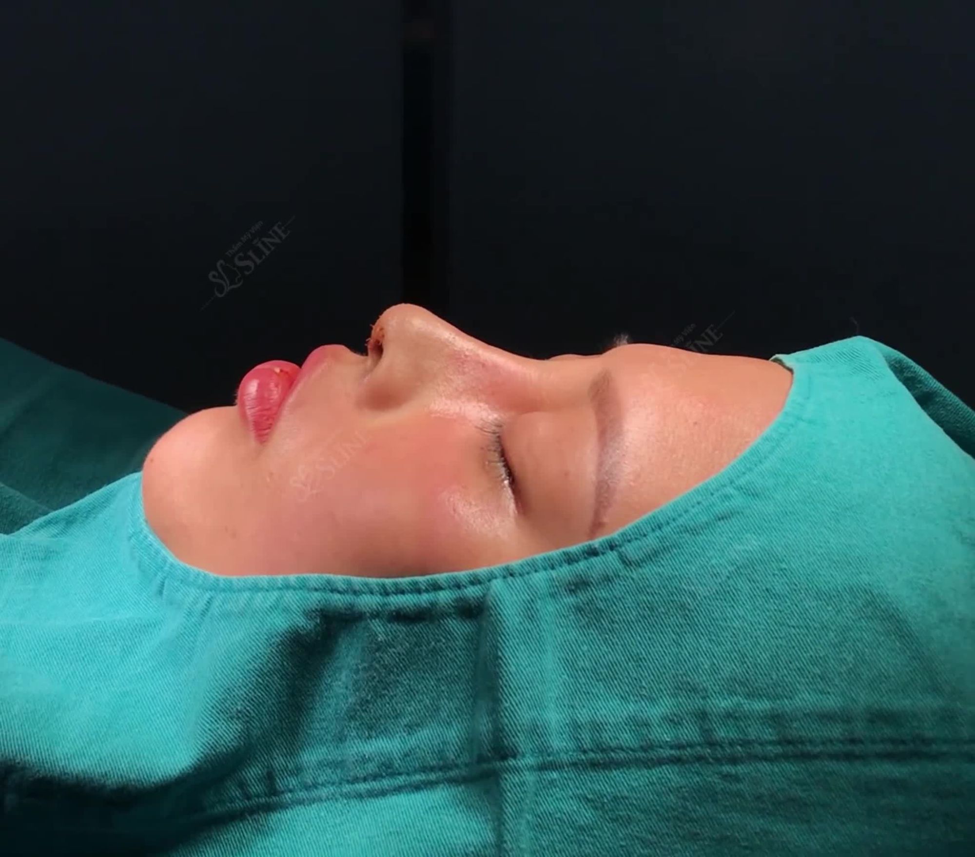 KẾT QUẢ Dáng mũi cấu trúc sau 45 phút phẫu thuật với ekip Sline