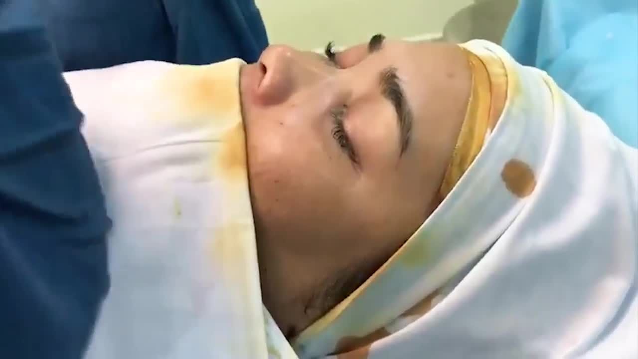 MŨI GÃY, ĐẦU MŨI NGẮN, DA MŨI MỎNG SẼ THẾ NÀO SAU NÂNG MŨI SỤN SƯỜN SURGIFORM???