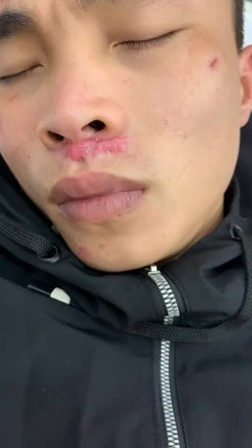 Sẹo lồi lớn do tai nạn, nhiễm trùng da - Chữa nhanh khi còn có thể!