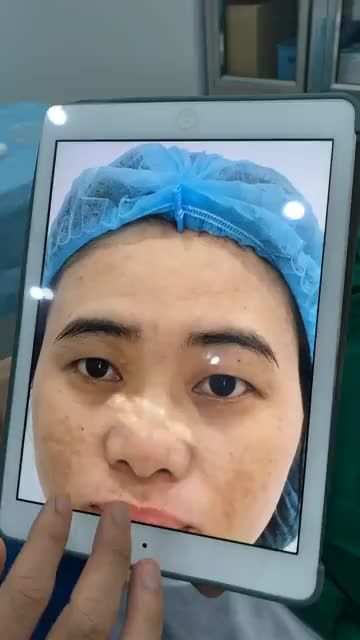 CẮT MÍ TRÊN