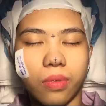 HÌNH ẢNH TRƯỚC NÂNG MŨI CẤU TRÚC: SỐNG MŨI GÃY, ĐẦU MŨI TO THÌ NÊN NÂNG MŨI THẾ NÀO?
