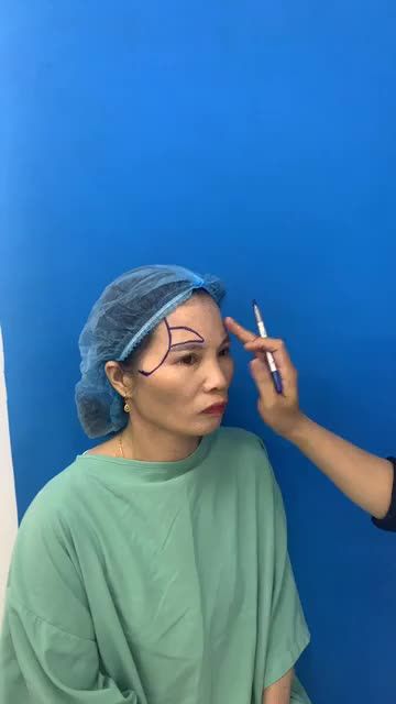 Cận cảnh quá trình đo vẽ cấy mỡ mặt