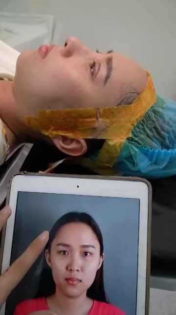 CA NÂNG MŨI CẤU TRÚC SỤN SURGIFORM + CẮT MÍ MINI DEEP VỪA MỚI THỰC HIỆN XONG