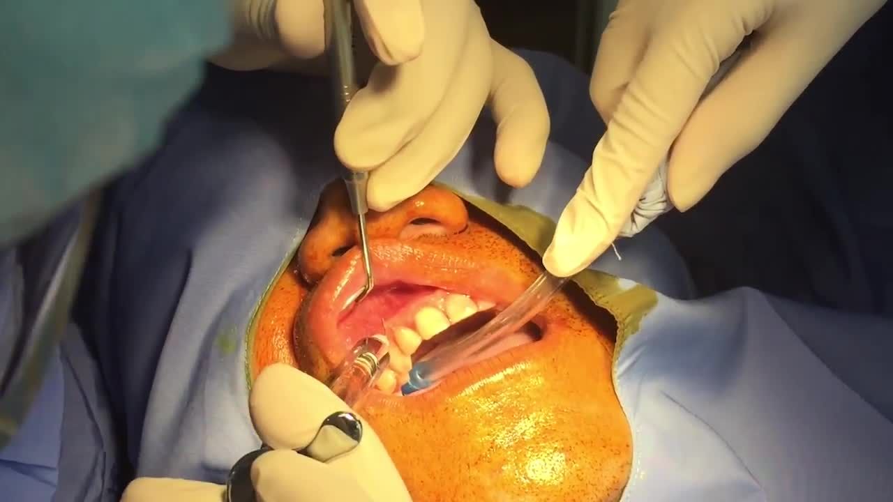 CẤY GHÉP IMPLANT PHỤC HÌNH RĂNG TẠM CHỈ TRONG 1 LẦN PHẪU THUẬT| NHA KHOA THẾ HỆ MỚI