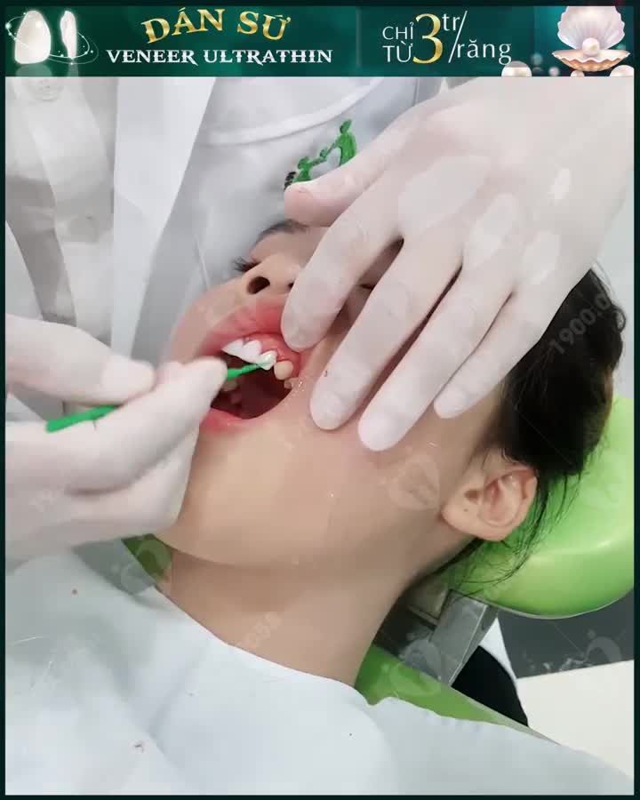 DÁN SỨ VENEER: NỤ CƯỜI ĐẸP SANG TỰ TIN TOẢ SÁNG
