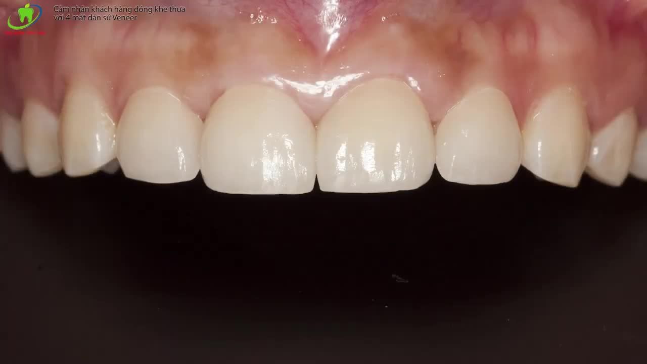 ĐẸP KHÔNG CẢN TRỞ CÙNG THẨM MỸ VENEER